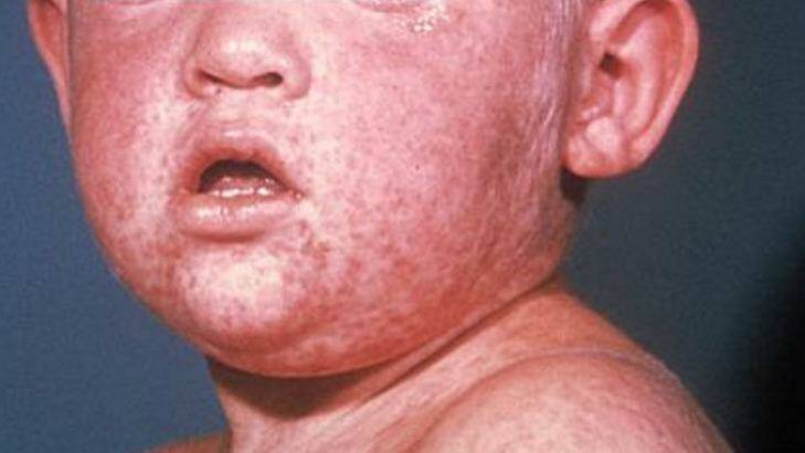 The measles rash on the face of a child. Photo: Centers for Disease Control and Prevention