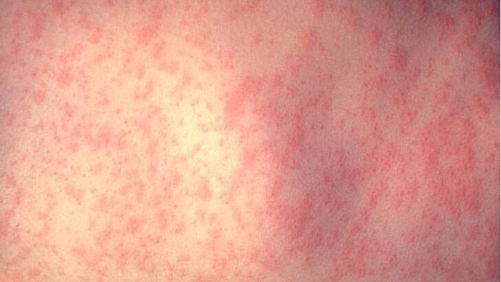 Latest measles case spent time at Powerhouse, shopping centre